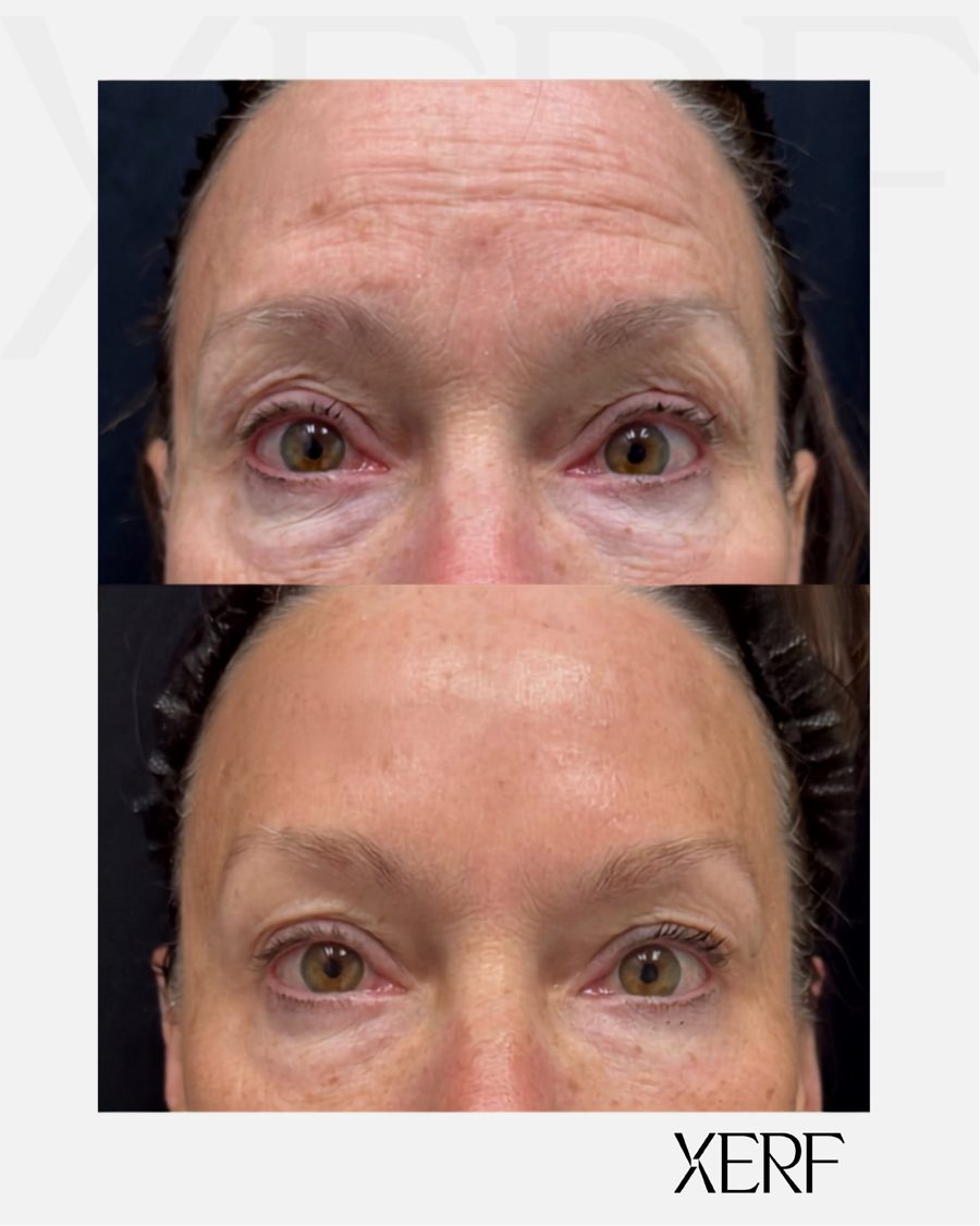 Antes e depois do XERF na BTZ Med, Novo Hamburgo: Olhos e testa